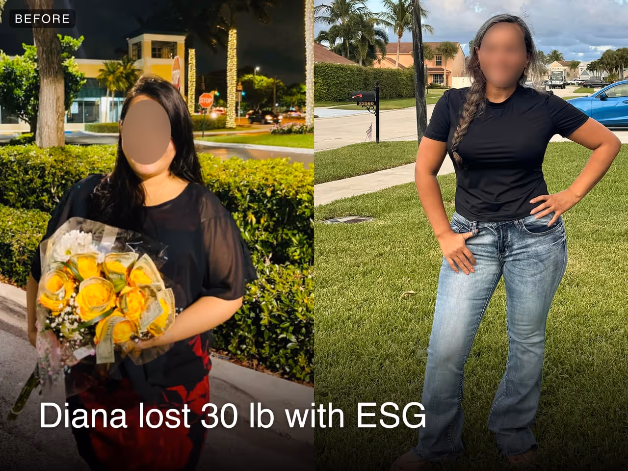 Before and after images of Diana who lost 30 pounds in 6 month through Everself's ESG Stomach Tightening® procedure