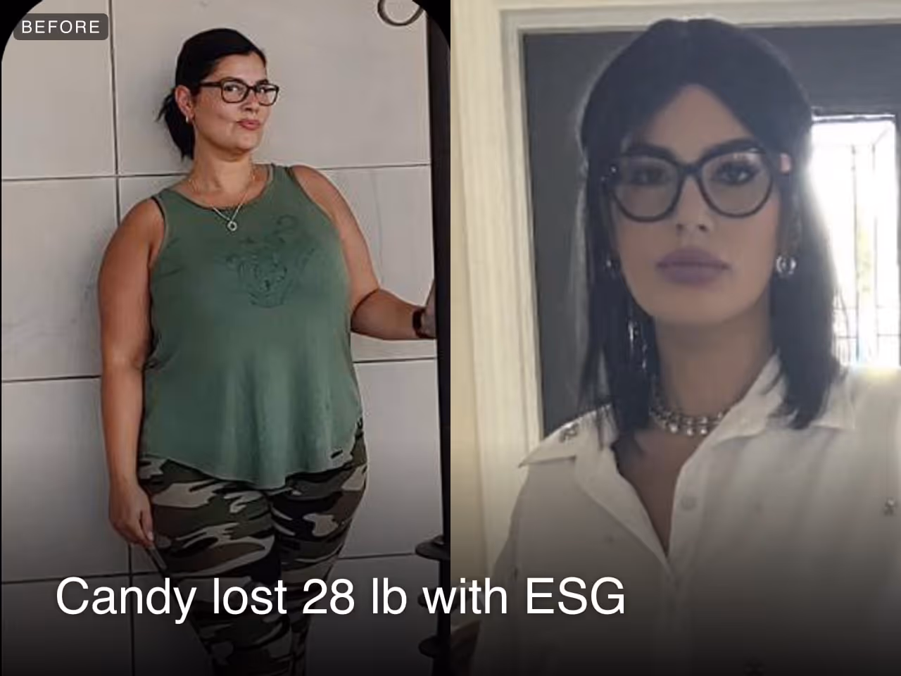 Before and after images of Candy who lost 28 pounds in 3 month through Everself's ESG Stomach Tightening® procedure