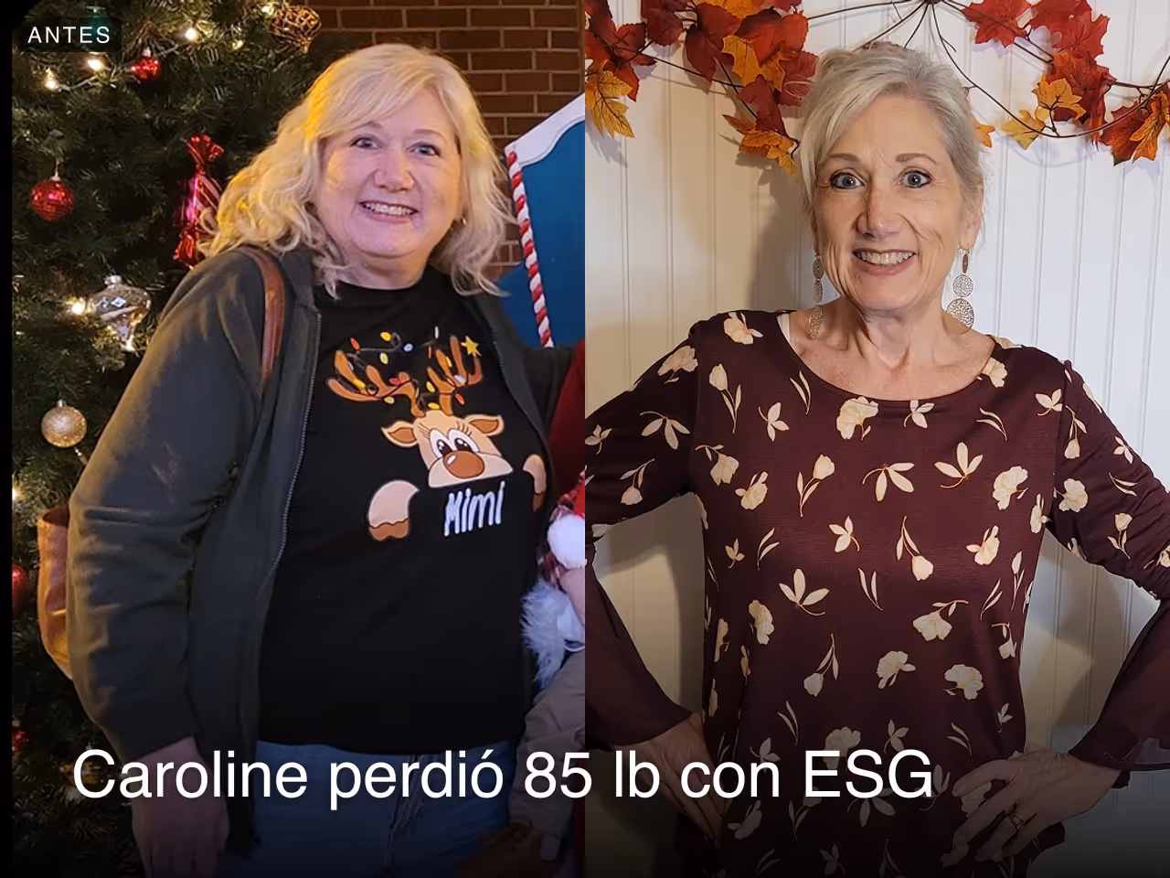 Caroline perdió 85 libras con una ESG de Everself