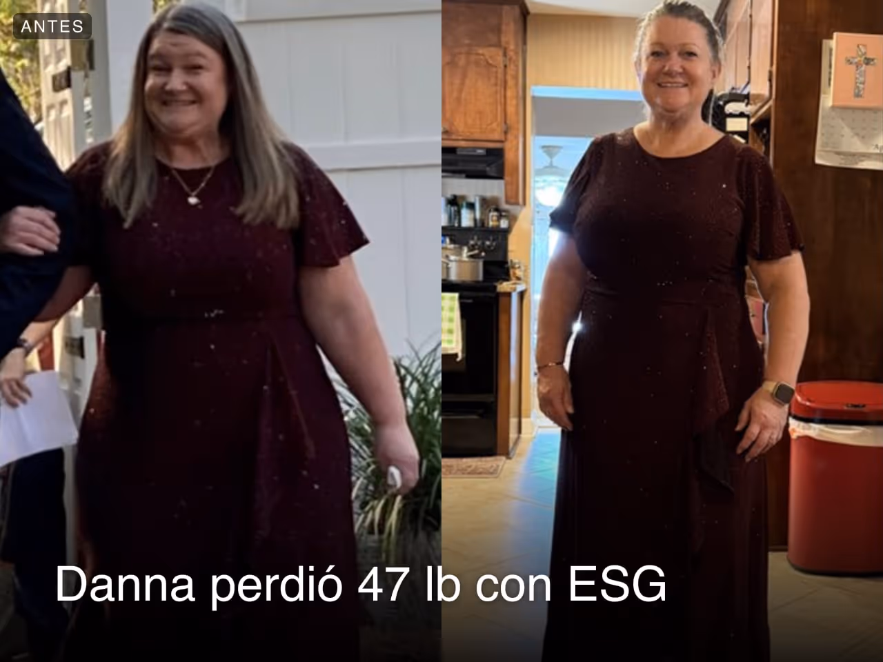Imagen de antes y después de Danna, quien perdió 47 libras en 4 meses con ESG