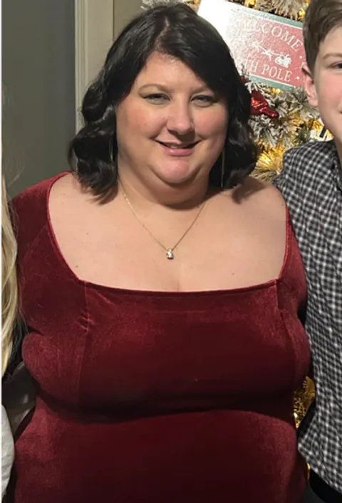 Mary before ESG Stomach Tightening