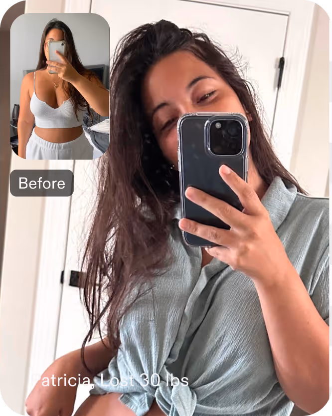 Before and after images of Patricia, a Everself ESG Stomach Tightening® patient who lost 30 pounds in 3 months