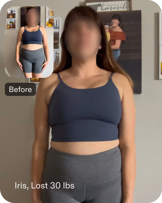Before and after images of Iris who lost 30 pounds in 4 months after a Gastric Balloon procedure with Everself