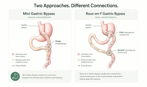 Diagrama anatómico que compara el mini bypass gástrico de una sola anastomosis con el bypass gástrico en Y de Roux, mostrando la bolsa estomacal y la reconfiguración del intestino.
