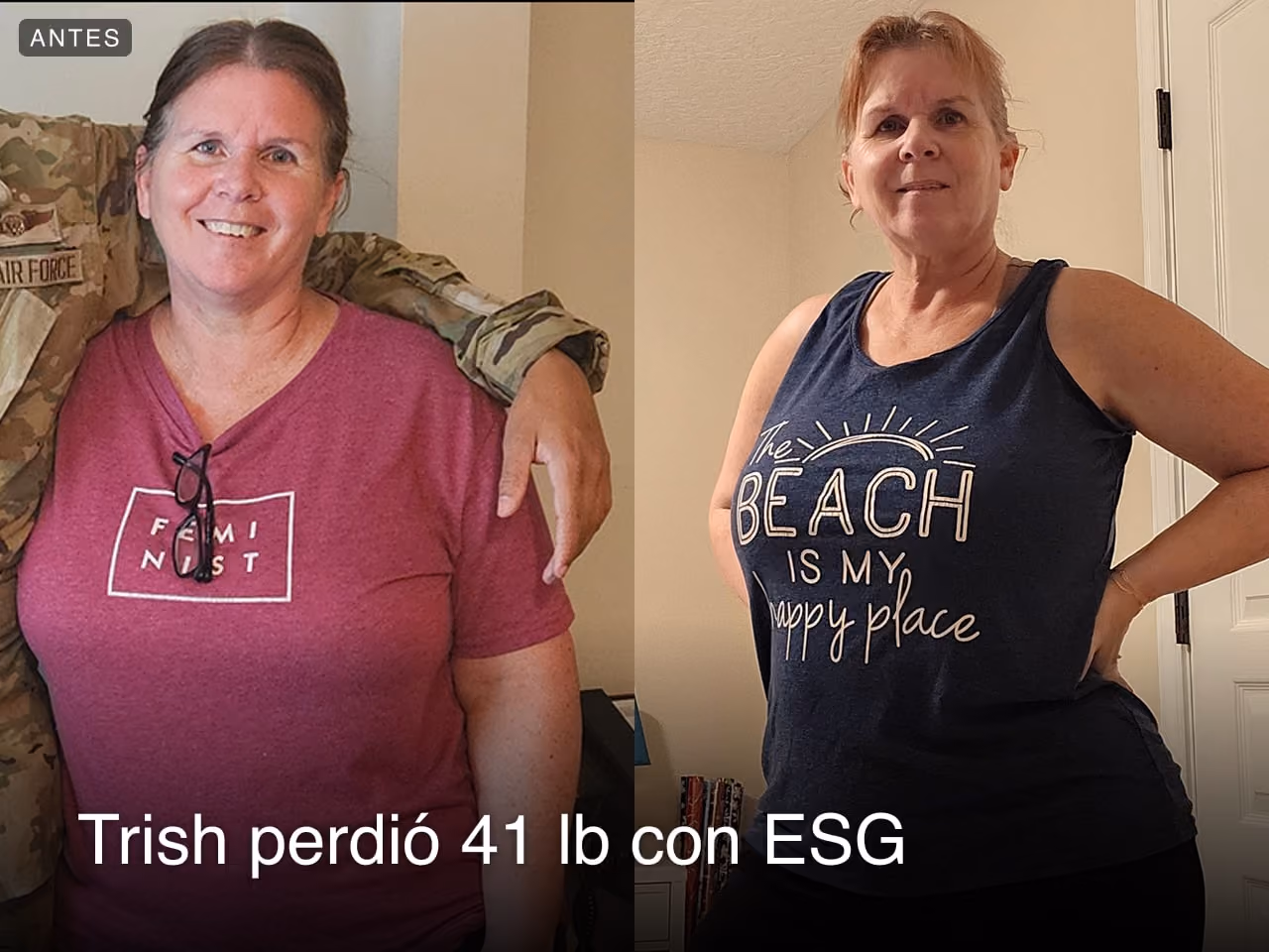 Trish perdió 41 libras después de una ESG con Everself