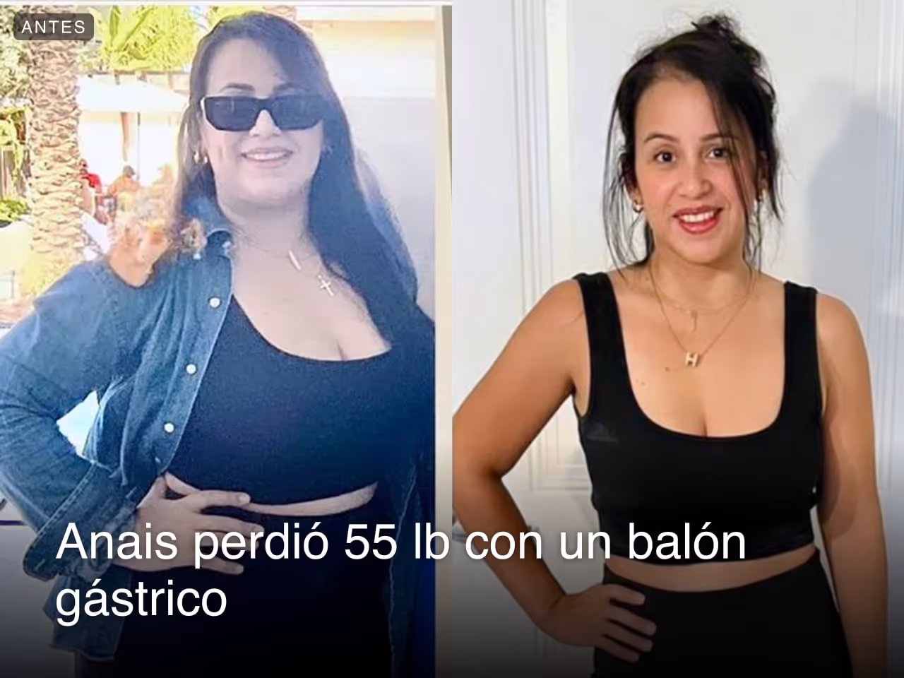 Imágenes de antes y después de Anaís, quien perdió 55 libras en 6 meses tras un balón gástrico con Everself.