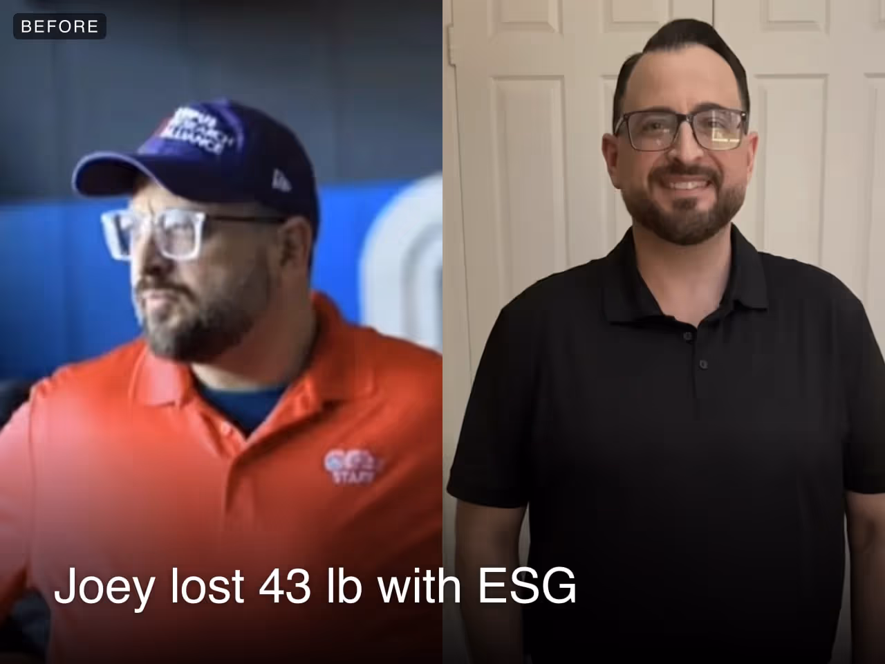 Joey lost 43 lbs with an ESG with Everself