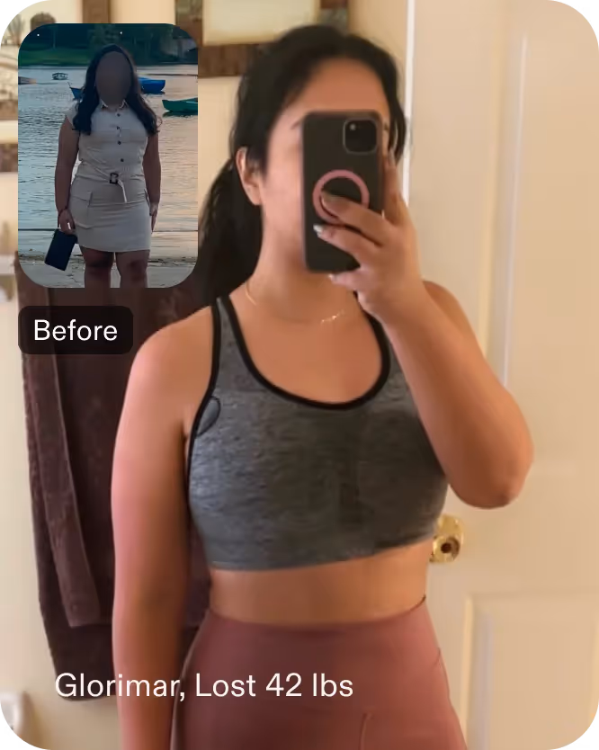 Before and after images of Glorimar who lost 43 pounds with a gastric balloon procedure