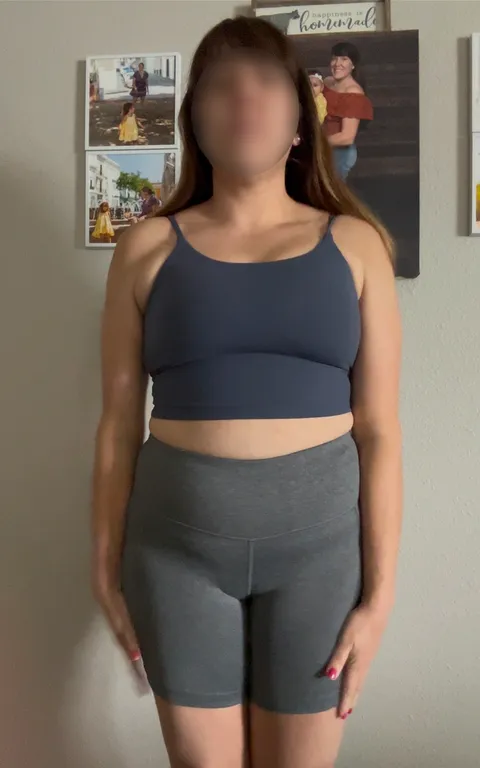 Iris after a gastric balloon