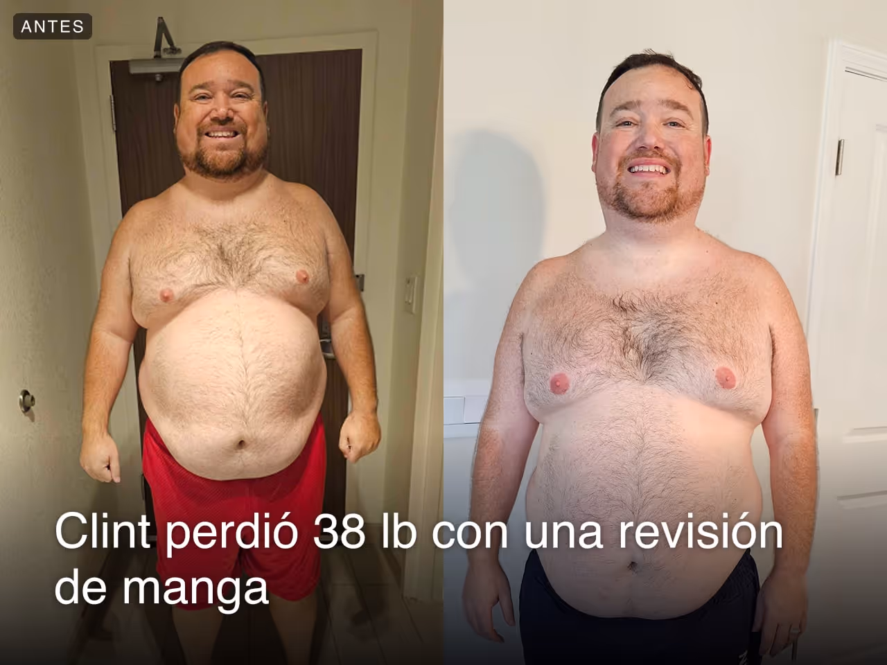 Clint perdió 38 libras con el procedimiento de revisión de gastrectomía en manga de Everself