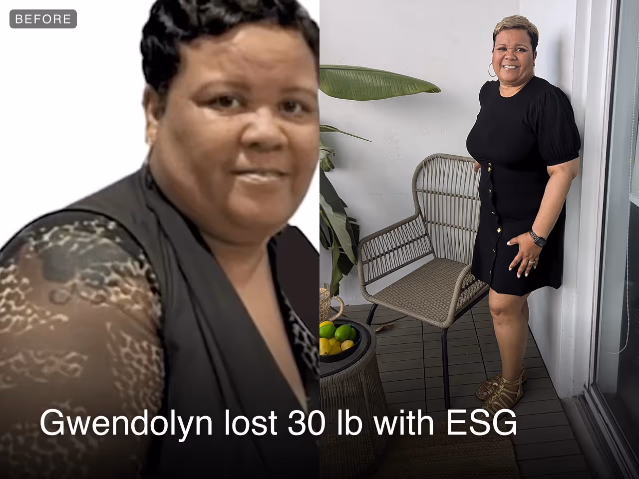 Before and after images of Gwendolyn who lost 30 pounds in 5 weeks after an ESG procedure