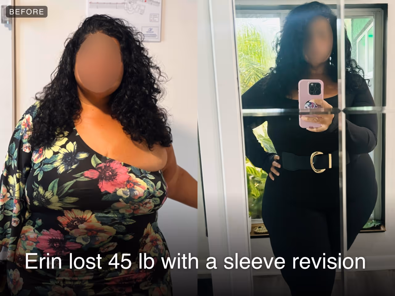 Before and after images of Erin who lost 45 pounds in 3 months after a Revision of Sleeve Gastrectomy Procedure - SIS with Everself