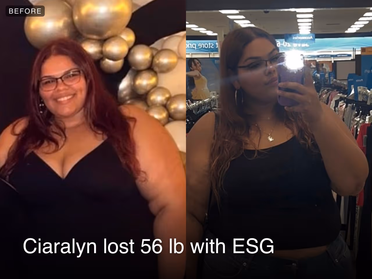 Ciaralyn lost 56 pounds in 3 months with an ESG from Everself