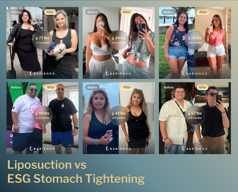 Before and after images of ESG stomach tightening patients