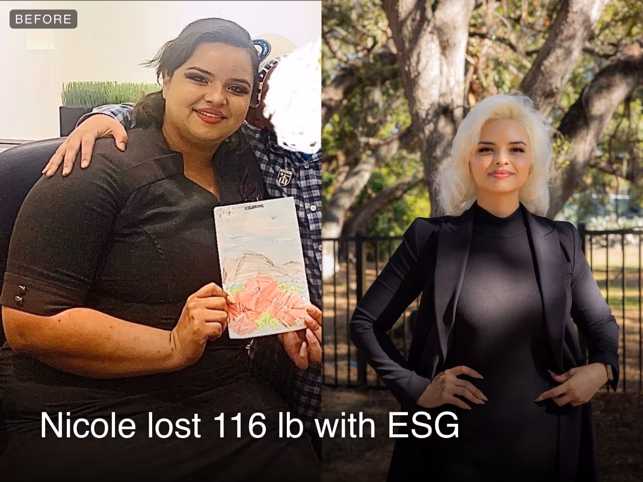 Before and after images of Nicole, an Everself ESG Stomach Tightening® patient who lost 116 pounds in 12 months