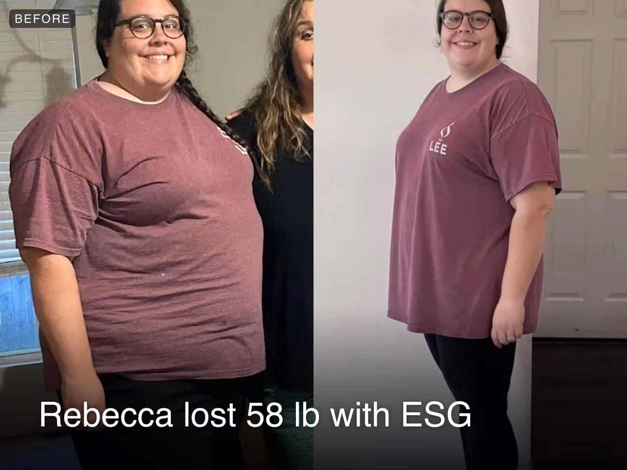 Before and after images of Rebecca who lost 58 pounds with an ESG procedure