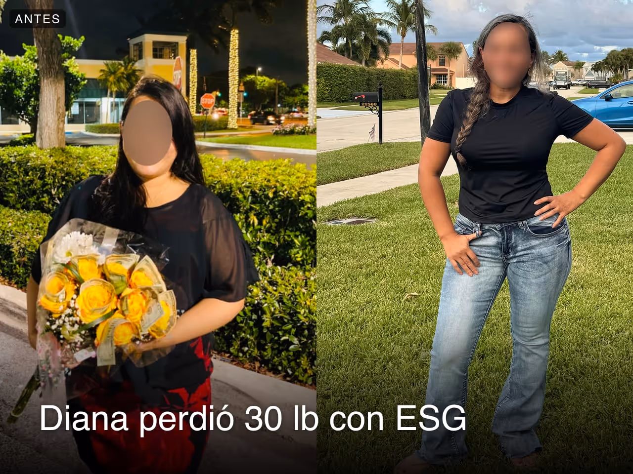 Imágenes de antes y después de Diana, quien perdió 30 libras en 6 meses con el procedimiento de Reducción de Estómago ESG de Everself