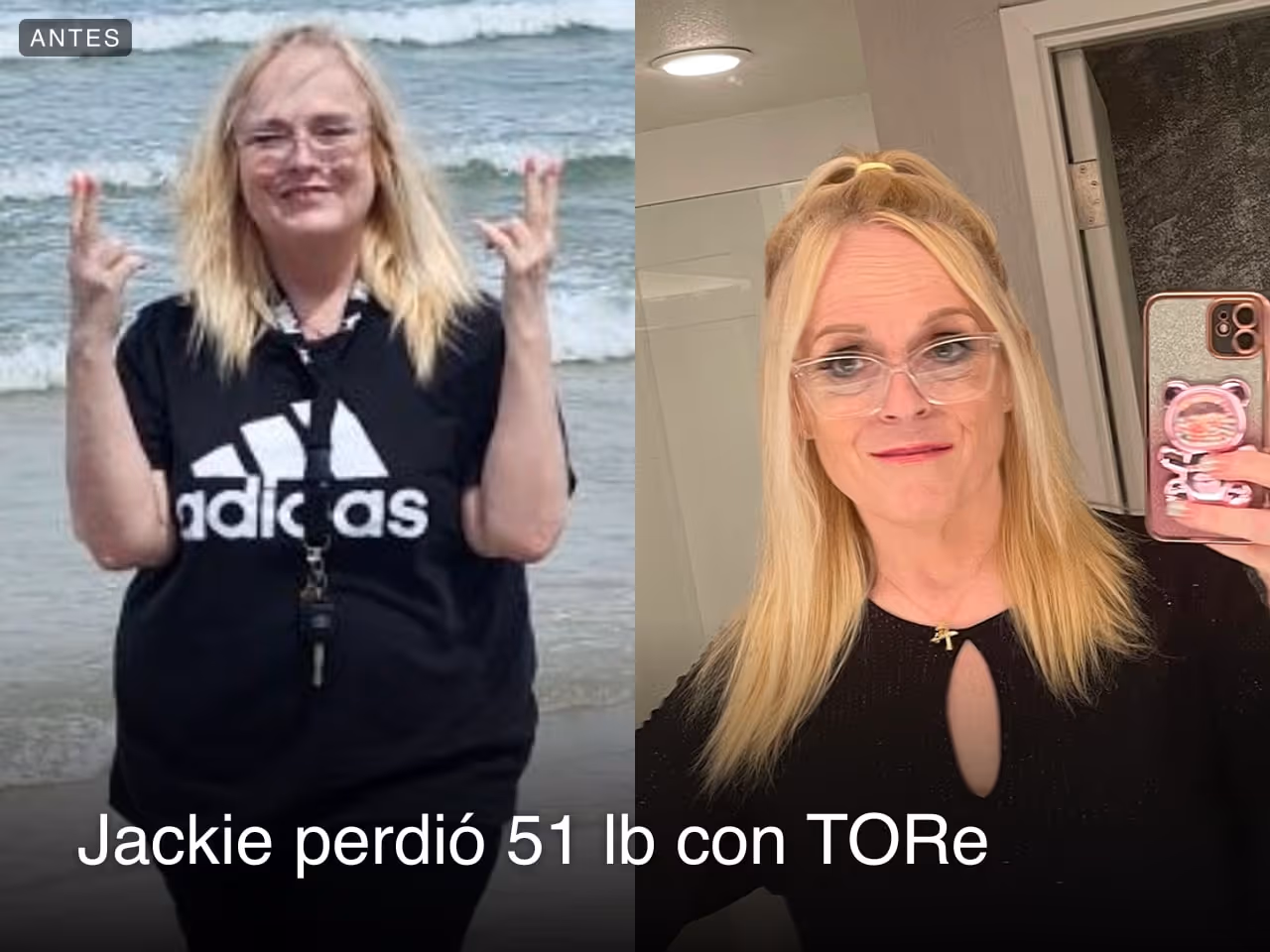 Imágenes de antes y después de Jackie, quien perdió 51 libras en 5 meses después de un procedimiento TORe con Everself