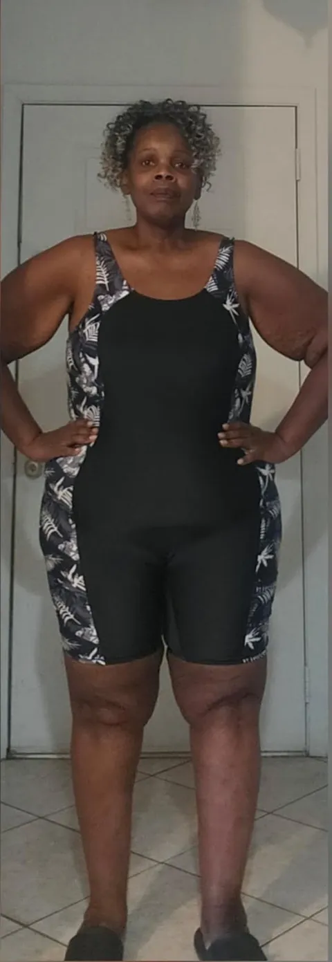 Regina after TORe gastric bypass revision