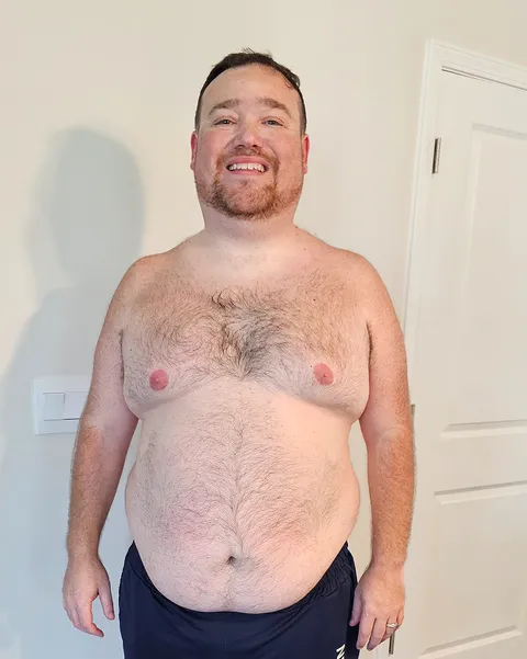 Clint after a gastric sleeve revision