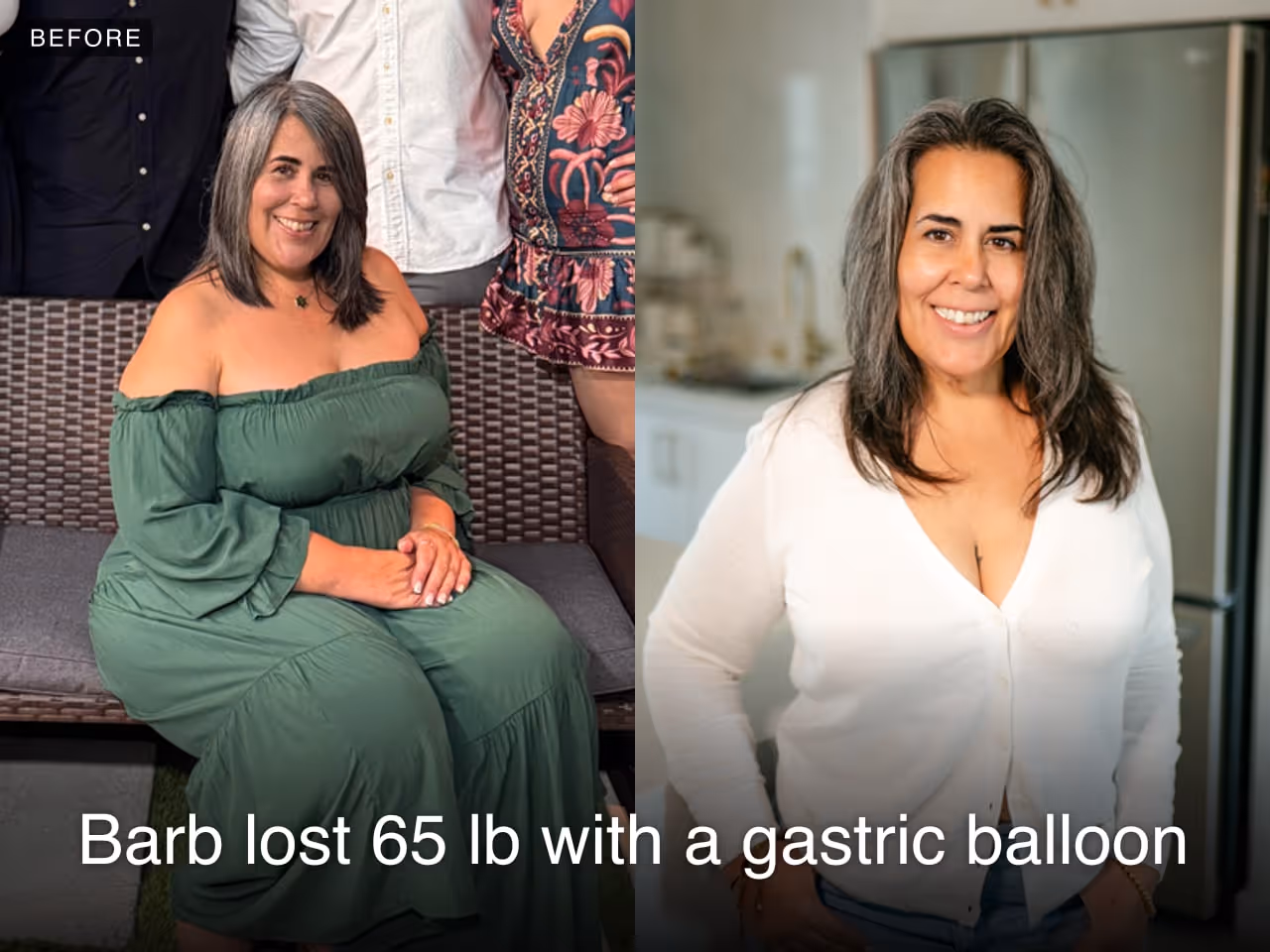 Before and after image of Barb who lost 65 lbs in 10 months with gastric balloon