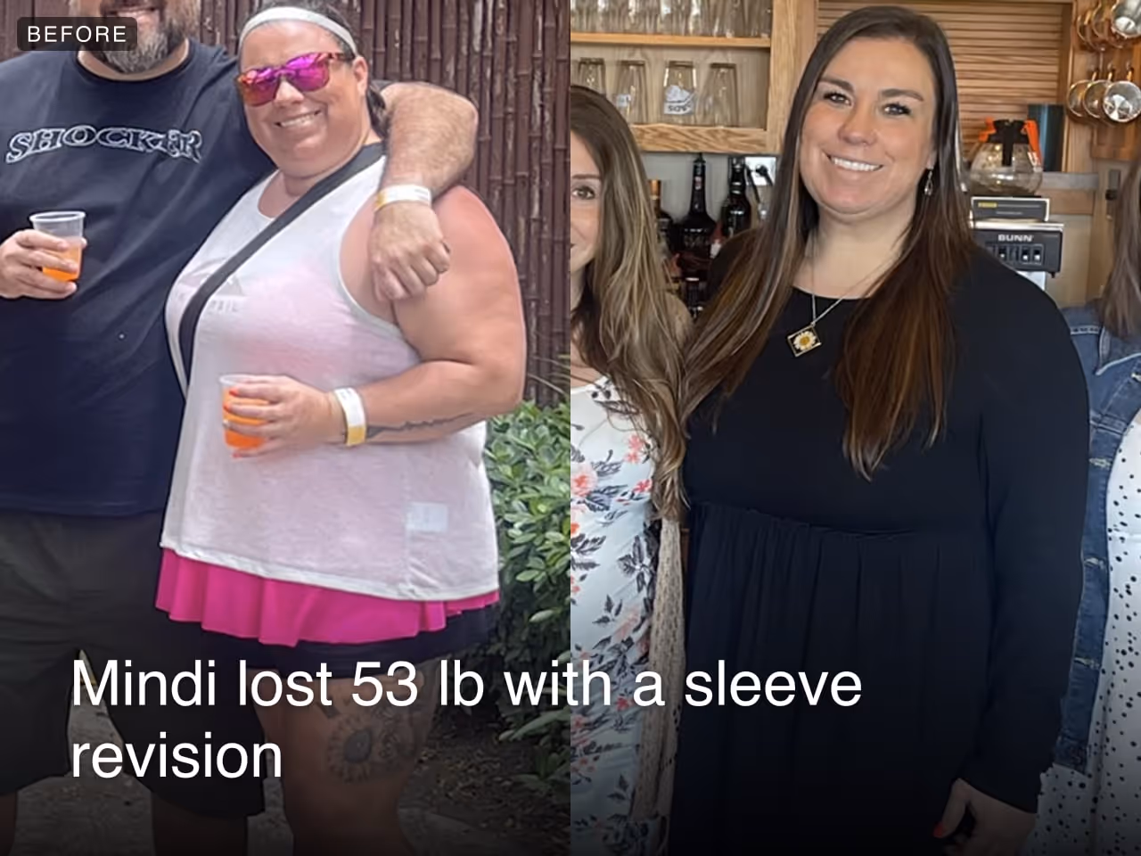 Before and after images of Mindi who lost 43 pounds in 4 months through Everself's non-surgical revision procedure