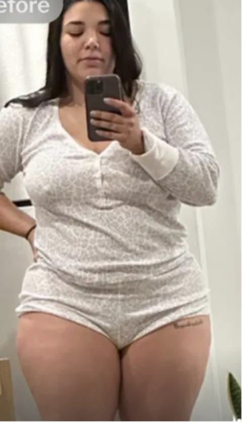 Ruxibeth before a gastric balloon