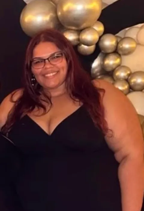 Ciaralyn before ESG Stomach Tightening