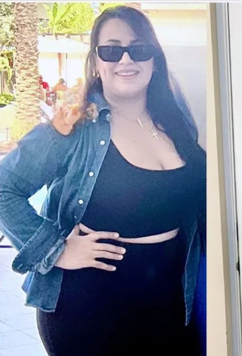 Anais before a gastric balloon
